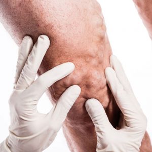 Causes of Venous Diseases - Varicose Veins